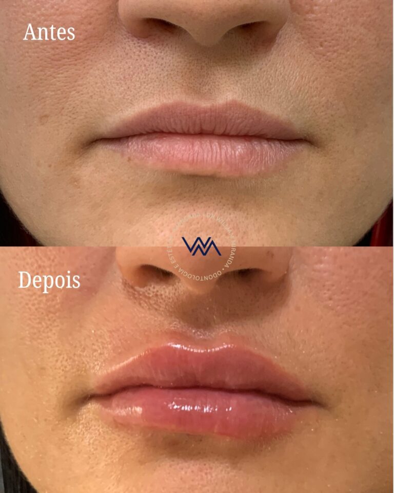 Preenchimento Labial